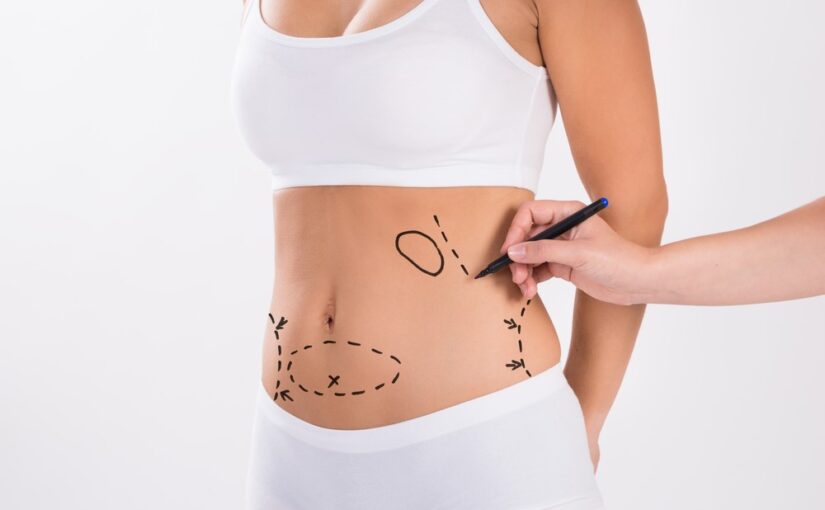 Recovery After Liposuction: Insights and Support from De Aesthetikos